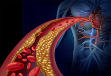 Colesterol elevado: Un peligro silencioso para el cuerpo humano