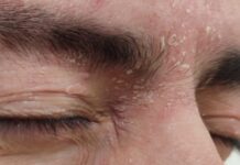 Cómo controlar La dermatitis seborreica: Guía completa de causas y tratamientos efectivos